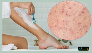 تیرگی و لک پوستی بعد از شیو با ژیلت، موبر، اپیلاتور، وکس
