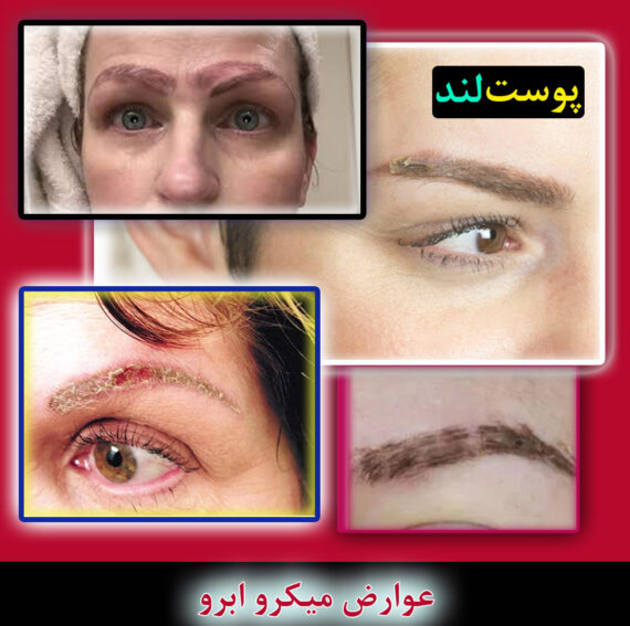 عوارض میکرو ابرو (میکروبلیدینگ) عوارض میکرو ابرو (میکروبلیدینگ)