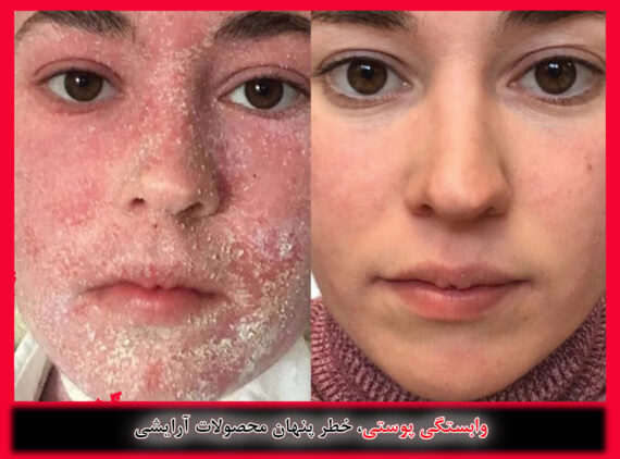 وابستگی پوستی وابستگی پوستی به مواد آرایشی