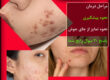 تیرگی بعد از جوش و آکنه