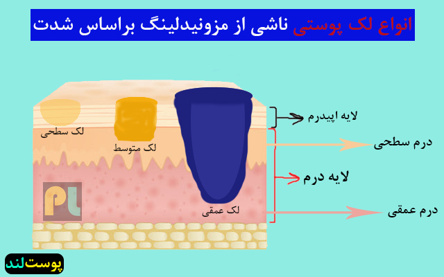 انواع لک پوستی و تیرگی بعد از مزونیدلینگ